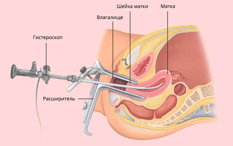 хирургическая гистероскопия