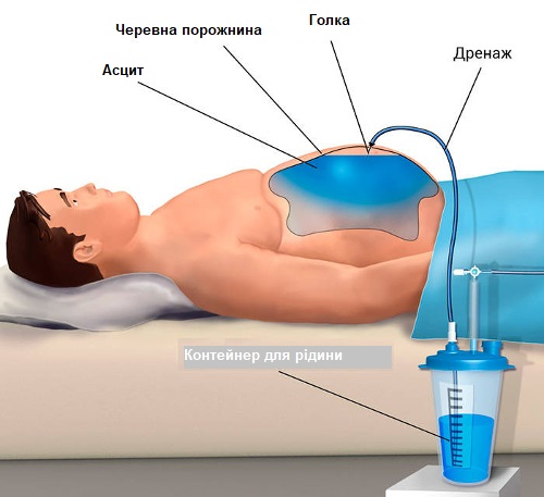 Лапароцентез 