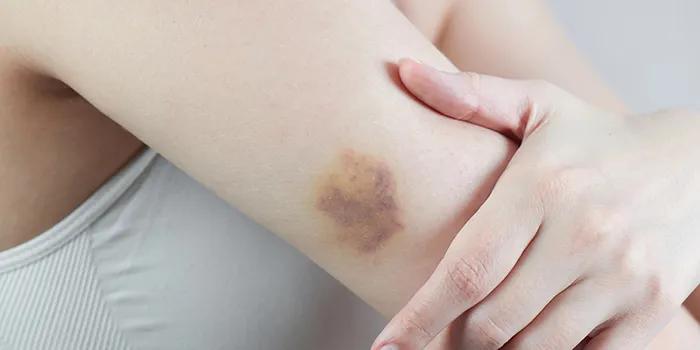 гематома на руці