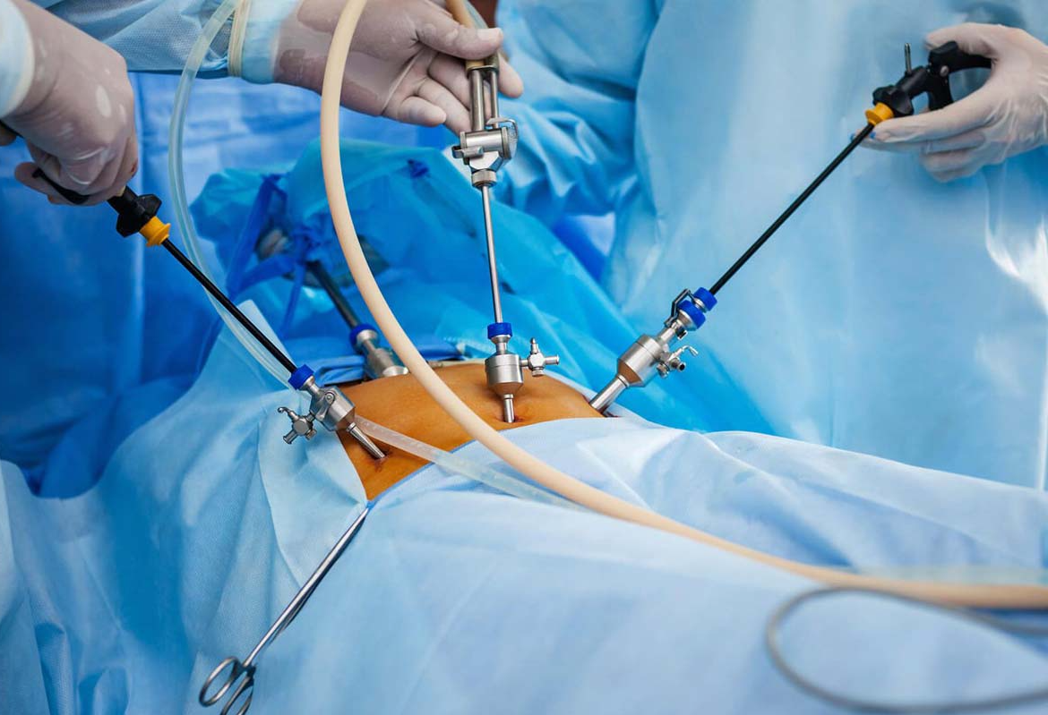 лапароскопия фото