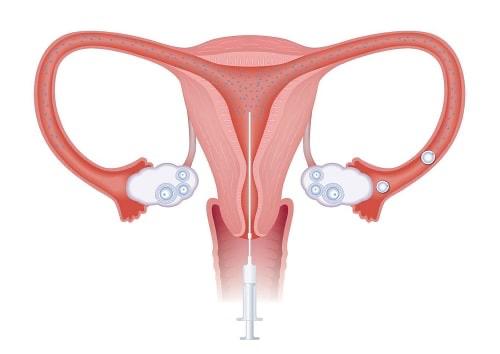 внутрішньоматкова інсемінація