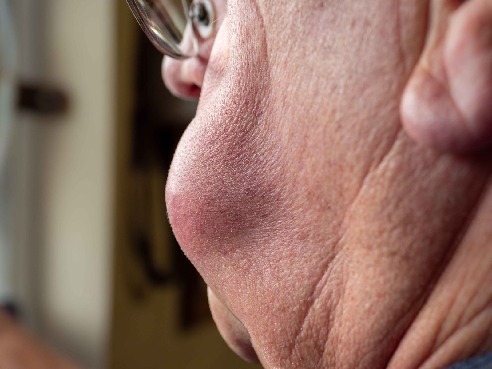 лечение абсцеса